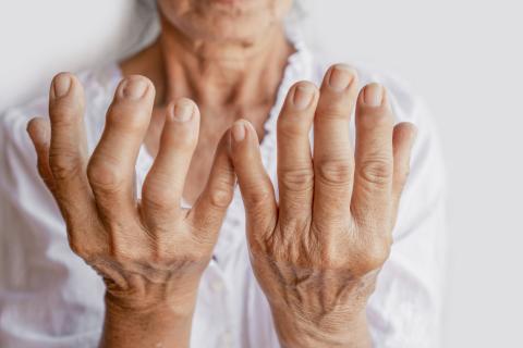 Ce nouveau médicament non seulement supprime l'inflammation, mais réduit également considérablement les scores de douleur rapportés par les patients (Visuel Adobe Stock 304058462) Ce nouveau médicament non seulement supprime l'inflammation, mais réduit également considérablement les scores de douleur rapportés par les patients (Visuel Adobe Stock 304058462)