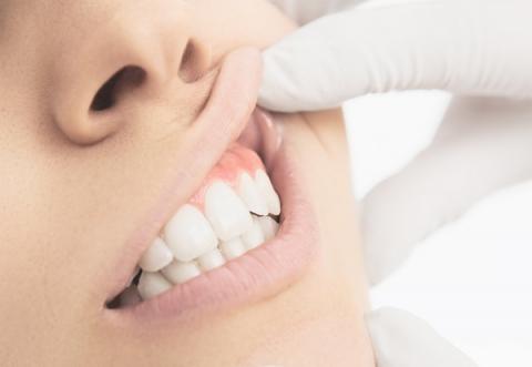 Environ 2,4 milliards de personnes -soit un tiers de la population mondiale- souffrent de caries dentaires non traitées (Visuel Adobe Stock 84742781) Environ 2,4 milliards de personnes -soit un tiers de la population mondiale- souffrent de caries dentaires non traitées (Visuel Adobe Stock 84742781)