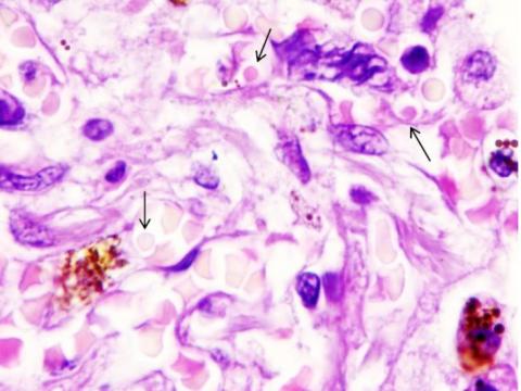 Cette attaque massive des globules rouges entraînerait des dommages aux neurones cérébraux, aux vaisseaux sanguins et aux organes internes, dont la fibrose pulmonaire serait l’une des manifestations les plus évidentes mais pas la seule (Visuel FEFU press office) Cette attaque massive des globules rouges entraînerait des dommages aux neurones cérébraux, aux vaisseaux sanguins et aux organes internes, dont la fibrose pulmonaire serait l’une des manifestations les plus évidentes mais pas la seule (Visuel FEFU press office)