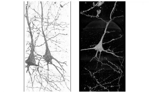 Les structures de ces neurones sont différentes et uniques chez chaque patient schizophrène, ce qui suggère que la maladie est associée à ces différences structurelles (Visuel Ryuta Mizutani) Les structures de ces neurones sont différentes et uniques chez chaque patient schizophrène, ce qui suggère que la maladie est associée à ces différences structurelles (Visuel Ryuta Mizutani)