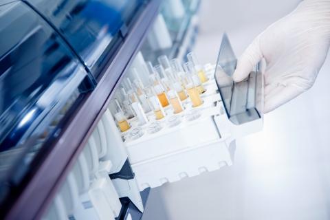 Avec l’utilisation de techniques d’intelligence artificielle (IA), il sera bientôt possible de détecter, en routine, les cancers par simple test d’urine (Visuel Adobe Stock 334065984) Avec l’utilisation de techniques d’intelligence artificielle (IA), il sera bientôt possible de détecter, en routine, les cancers par simple test d’urine (Visuel Adobe Stock 334065984)