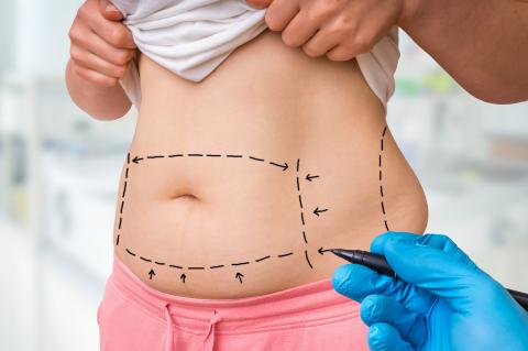 Enfin, si la liposuccion est généralement une procédure sûre, elle peut entraîner de très rares effets indésirables (Visuel Adobe Stock 219739310) Enfin, si la liposuccion est généralement une procédure sûre, elle peut entraîner de très rares effets indésirables (Visuel Adobe Stock 219739310)
