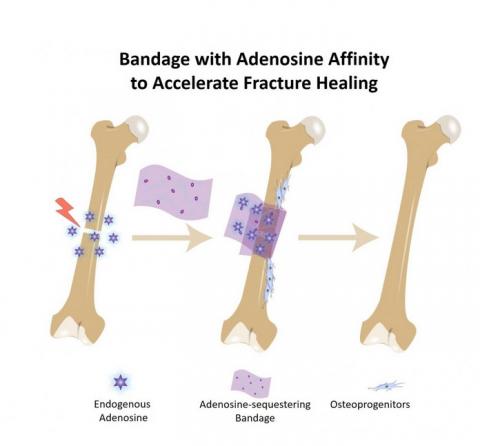 il s’agit d’un bandage de biomatériau appliqué directement sur l'os brisé qui contient des molécules de boronate qui s'accrochent à l'adénosine