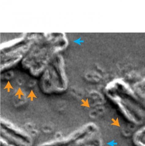 Ce phénomène connu sous le nom de « chromothripsie » est caractérisé par une rupture des chromosomes (flèches bleues sur schéma) et une circulation d'ADN extra-chromosomique (ADNc) (flèches orange)(Visuel Paul Mischel, UC San Diego) Ce phénomène connu sous le nom de « chromothripsie » est caractérisé par une rupture des chromosomes (flèches bleues sur schéma) et une circulation d'ADN extra-chromosomique (ADNc) (flèches orange)(Visuel Paul Mischel, UC San Diego)