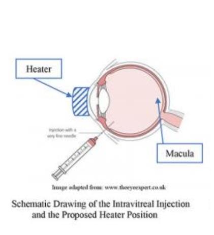 Une étape de chauffage léger après l'injection pourrait optimiser l'efficacité des anti-VEGF