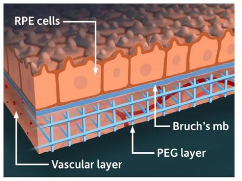Le modèle combine des tissus rétiniens dérivés de cellules souches et des réseaux vasculaires de patients humains reproduits avec des matériaux synthétiques, dans une « matrice » tridimensionnelle (Illustration de l'Université de Rochester / Michael Osadciw) Le modèle combine des tissus rétiniens dérivés de cellules souches et des réseaux vasculaires de patients humains reproduits avec des matériaux synthétiques, dans une « matrice » tridimensionnelle (Illustration de l'Université de Rochester / Michael Osadciw)