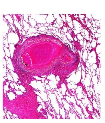 Tissu pulmonaire humain d'un patient tuberculeux avec lésion granulomateuse nécrosante centrale