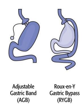 La dérivation gastrique Roux-en-Y, une des chirurgies bariatriques les plus pratiquées