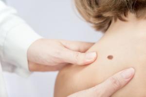 La solution topique peut constituer une option efficace mais moins toxique et « mieux cicatrisante » pour les patients présentant cette forme de croissance cutanée non cancéreuse. 