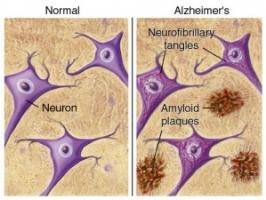 La protéine en question, présente à niveau élevé dans le liquide céphalo-rachidien annonce un déclin très rapide des capacités cognitives