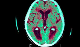Certaines mutations génétiques sont liées à des formes héréditaires de la maladie d'Alzheimer précoce
