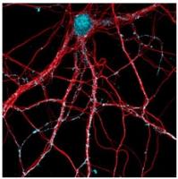 Des anticorps spécifiques capables de stopper la maladie d'Alzheimer ?