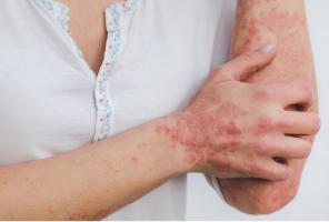 De nombreuses études ont montré que les patients atteints de psoriasis encourent un risque accru de maladies cardiovasculaires (Visuel Estzer Miller pour le Chinese Medical Journal)